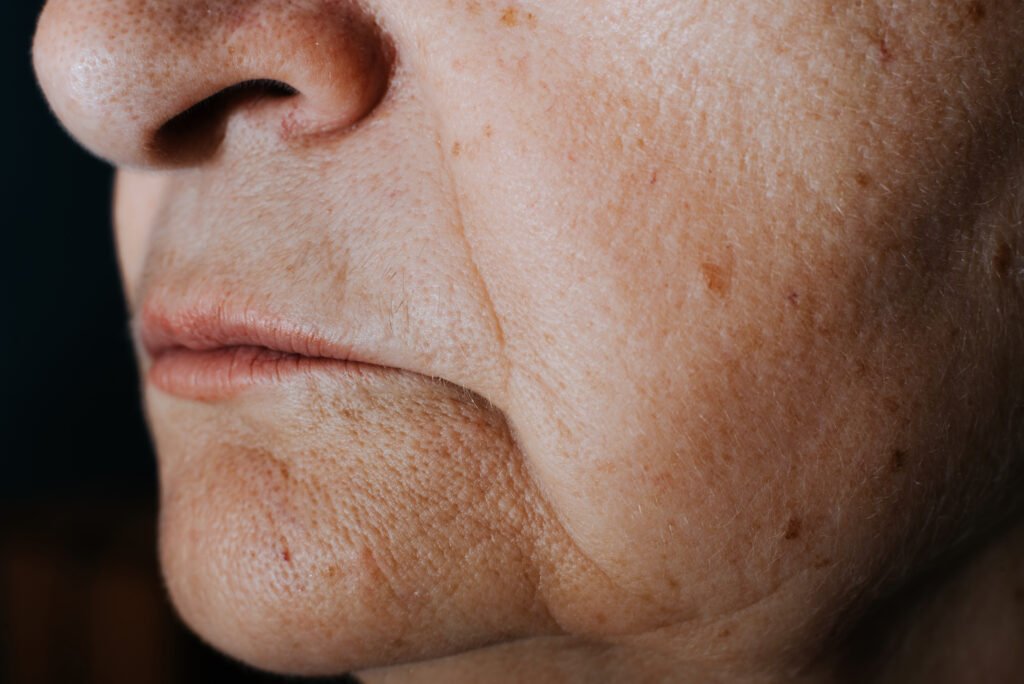 flacidez facial