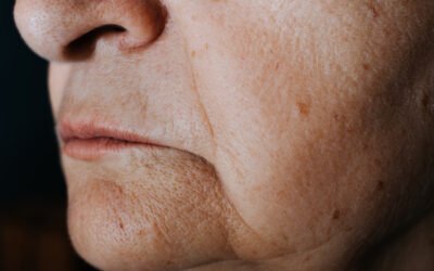 flacidez facial